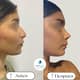 Slider image (10) Dra. Renata Cardenas-Aesthetic & Fuctional Rhinoplasty